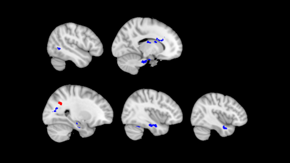 MRI brain scans showing areas of difference in white matter tracts