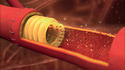 Sugary stent eases suturing of blood vessels