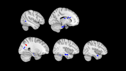 Nebraska study shows brain structure altered by childhood physical abuse