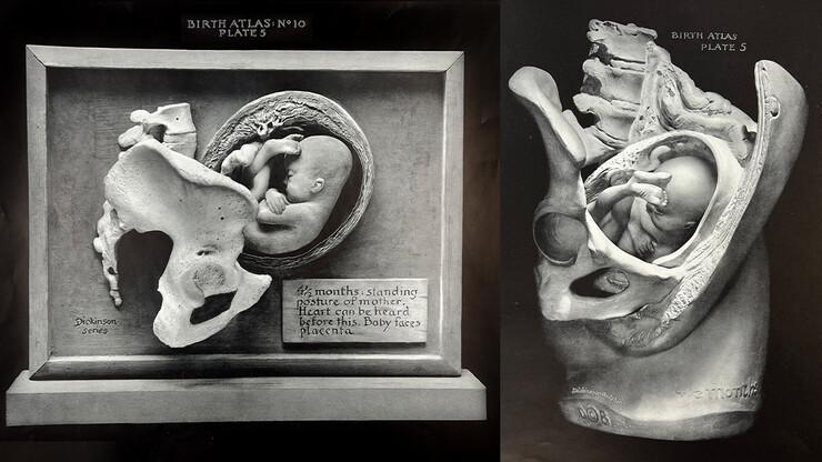 On the left is an image of Plate 5 from the first edition of the Birth Series, as photographed for the Birth Atlas. On the right is Plate 5 from a subsequent edition of the Birth Atlas, as depicted in the second series of sculptures. 