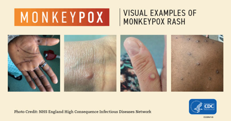 Images of a monkeypox infection. Credit NHS England High Consequence Infectious Disease Network